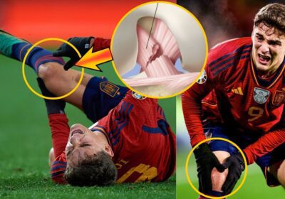 Pablo Gavi Complete Tear of ACL Will Sideline Him For More Than 7 Months