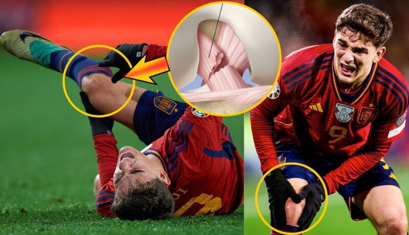 Soccer-From the sidelines: One participant’s battle to return from ACL damage Pablo Gavi Complete Tear of ACL Will Sideline Him For More Than 7 Months